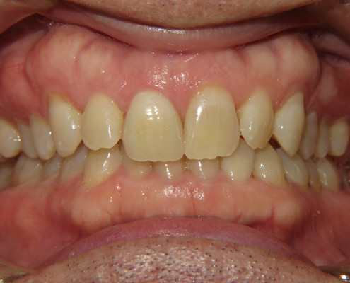 After Cosmestic and Laser Dentistry