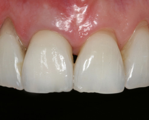 Final result of dental shading process